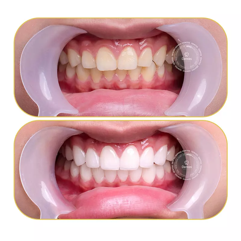 Hot Streamer Kairon với nụ cười mới hoàn mỹ hơn